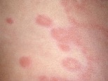 urticaria